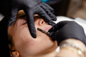 A close up on a patient's face as she receives dermaplaning near Mountain Lakes, NJ